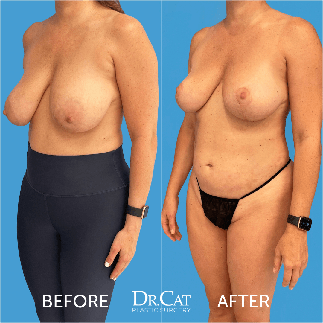 debbie lamanna recommends Huge Tits Sagging